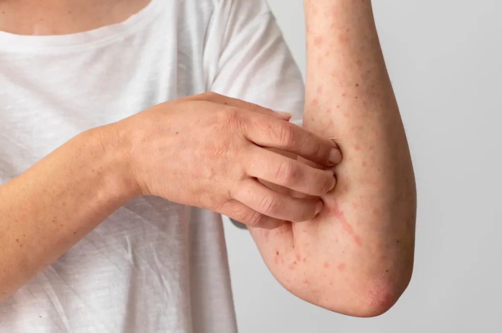 Allergie cutanée